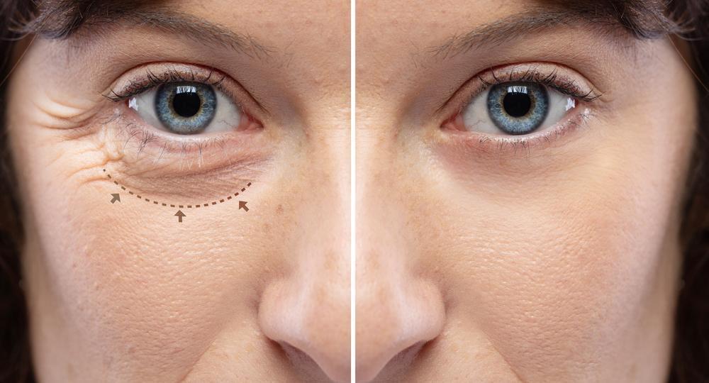 העור מסביב לעיניים: לפני ואחרי טיפול בוטוקס 